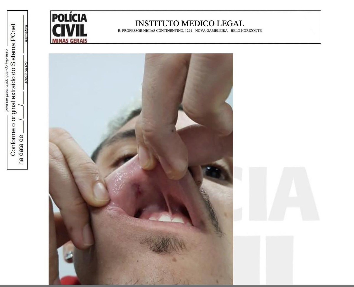 Laudo mostra ferimento na boca de Pedro, do Flamengo, após soco