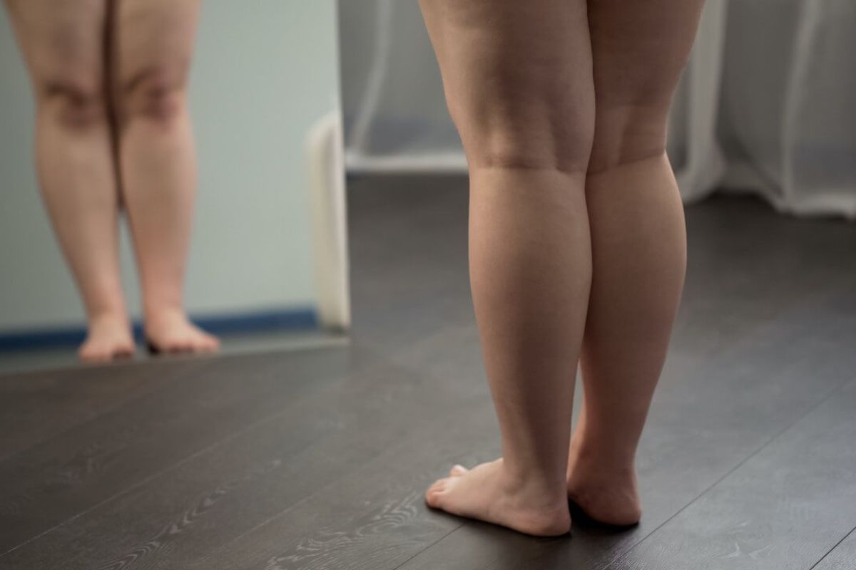 Lipedema: nutricionistas indicam suplementos para tratar o problema